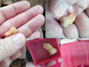 Wisdom tooth collage