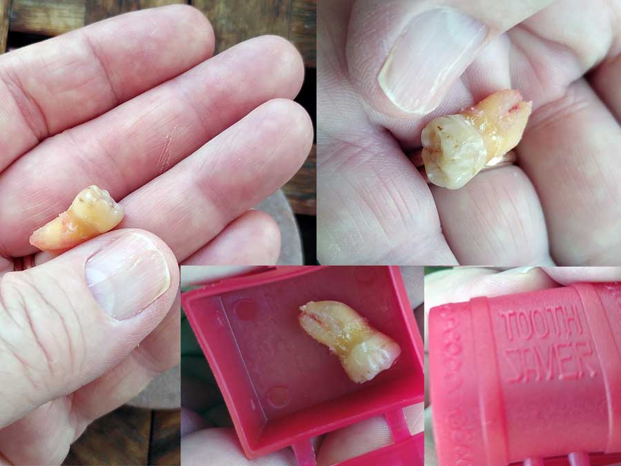 Wisdom tooth collage